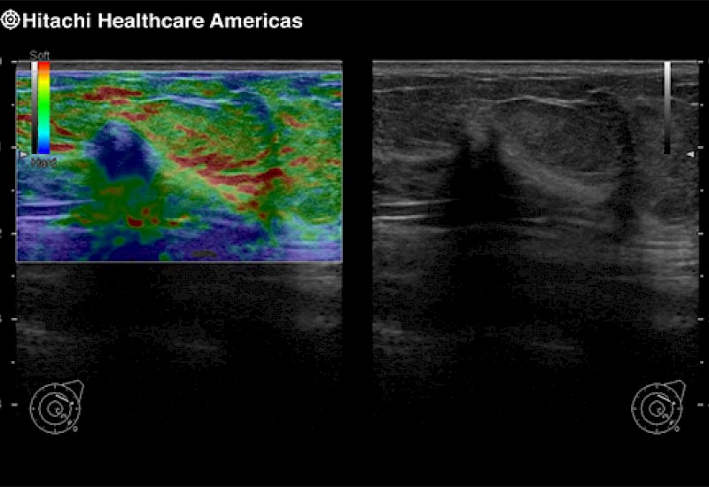 Breast Lesion Elastography