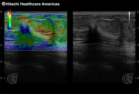 Breast Lesion Elastography