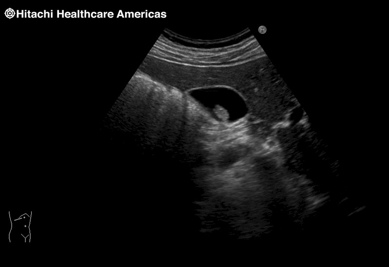 Gall Bladder NonShadowing Stone