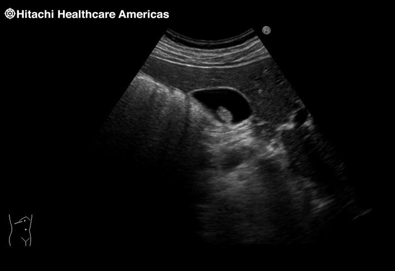 Gall Bladder NonShadowing Stone
