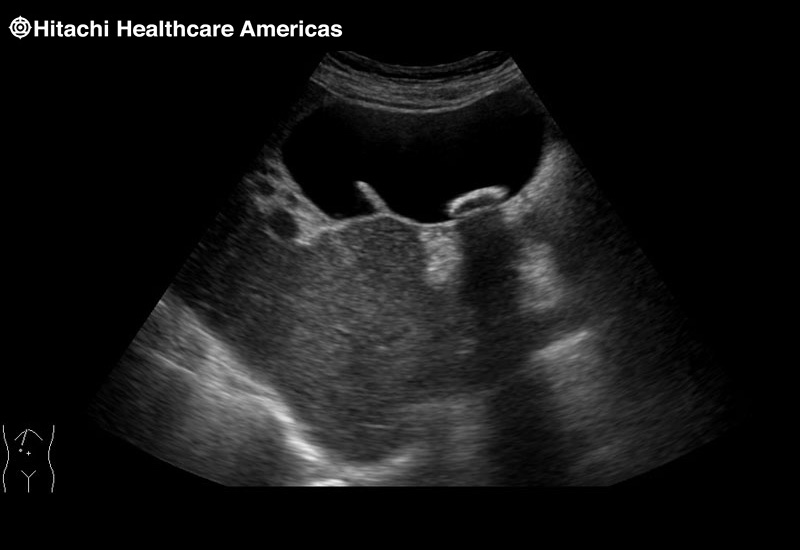 Gall Bladder Shadowing Stone