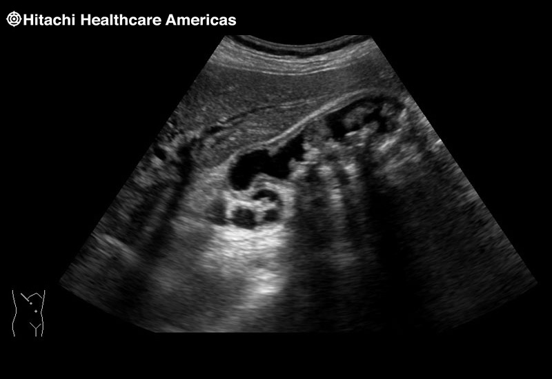 Gall Bladder Shadowing Stone