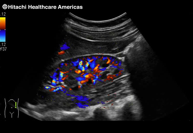 Kidney Doppler