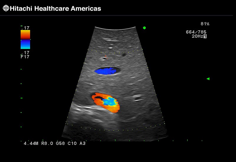 Liver Color Doppler