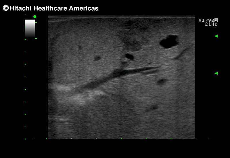 Liver Mild Hepatocellular Disease