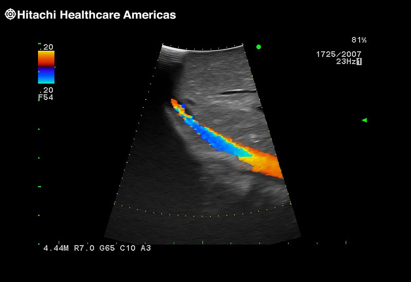 Liver Color Doppler
