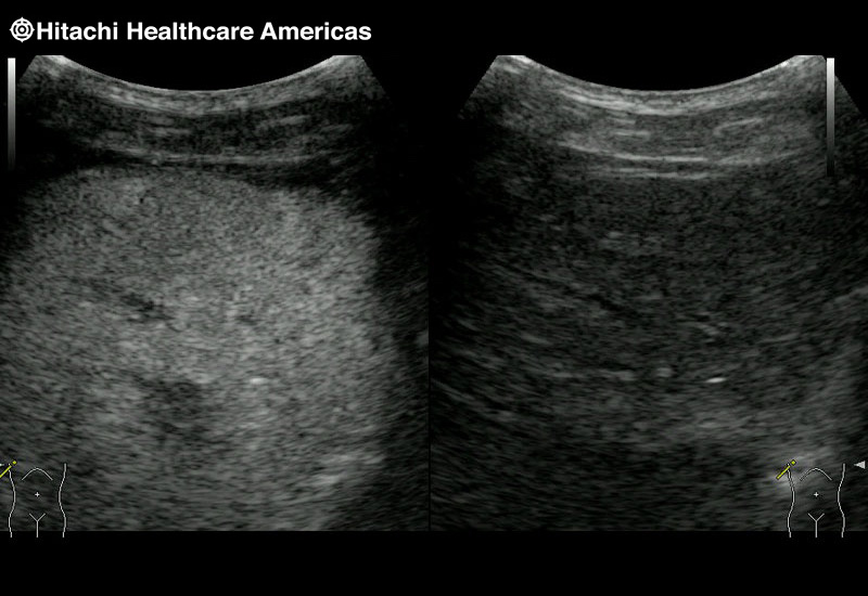 Liver Lesion Contrast