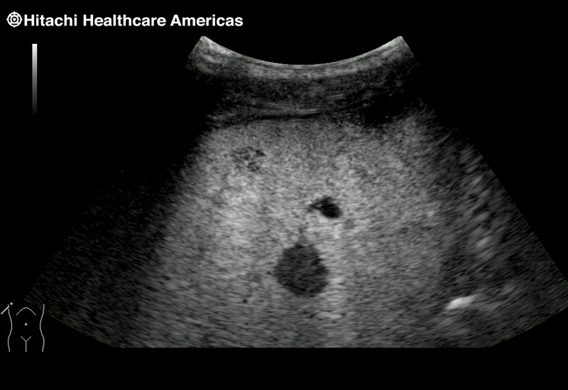 Liver Lesion Contrast