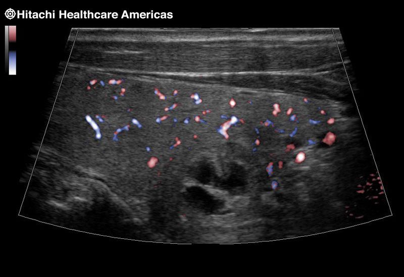 Thyroid Trapezoid eFlow