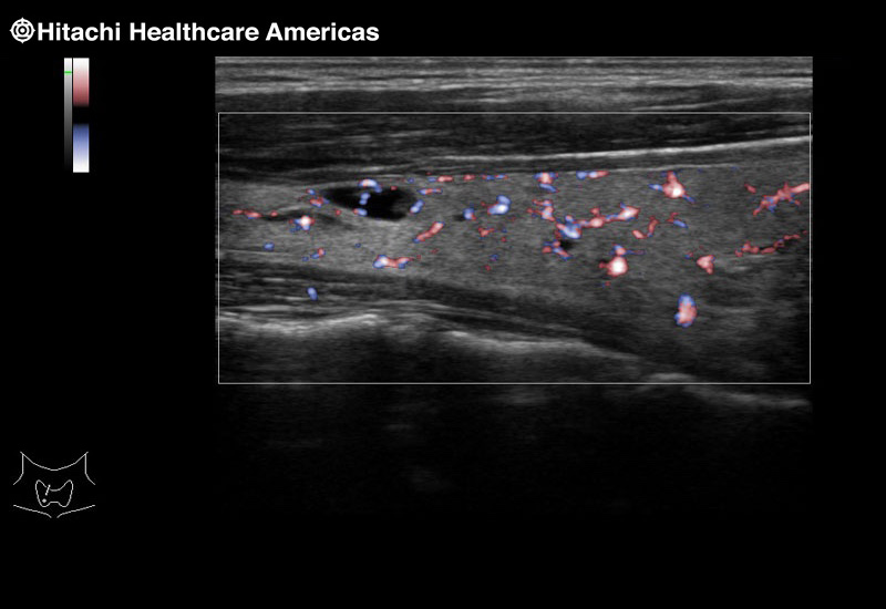 Thyroid Cyst eFlow