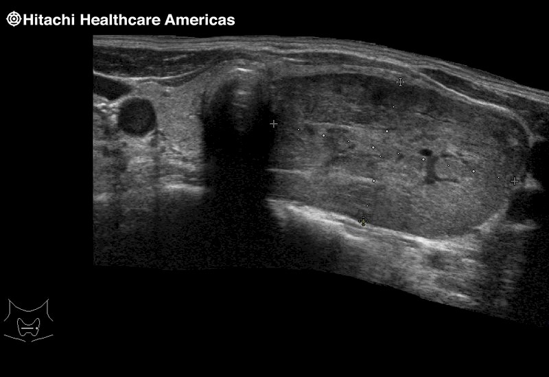 Thyroid Lesion Extended Field of View EFV
