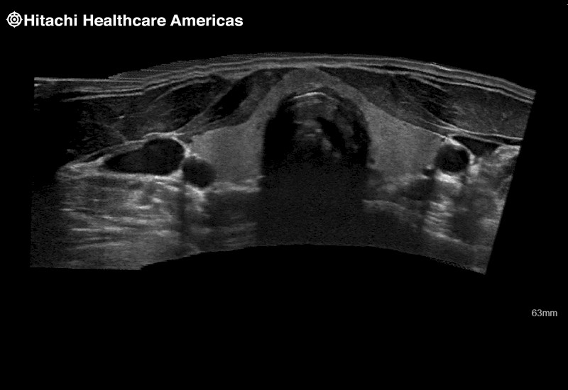 Thyroid Extended Field of View EFV