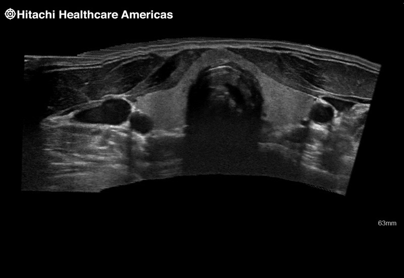 Thyroid Extended Field of View EFV