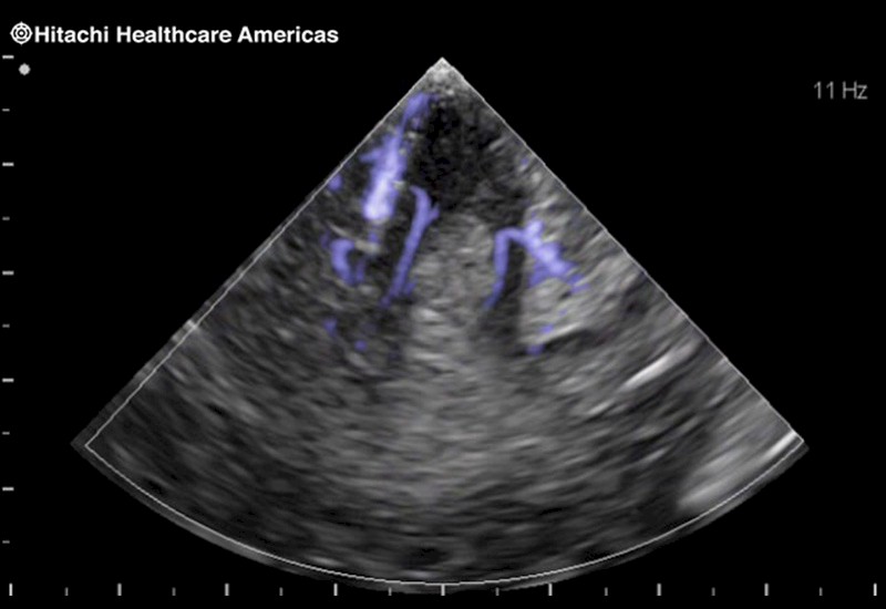 Brain Tumor with Blood Flow