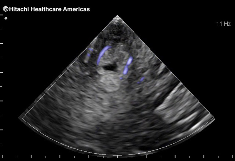 Brain Tumor with Blood Flow