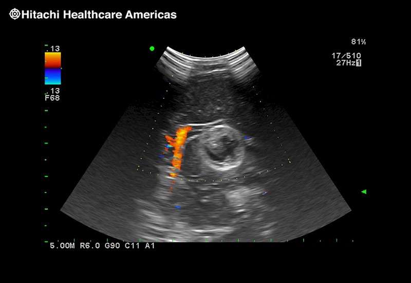 Brain Tumor with Blood Flow