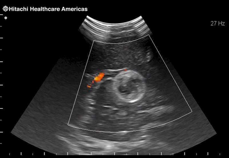 Brain Tumor with Blood Flow