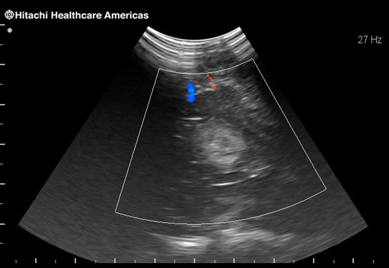 Brain Tumor with Blood Flow