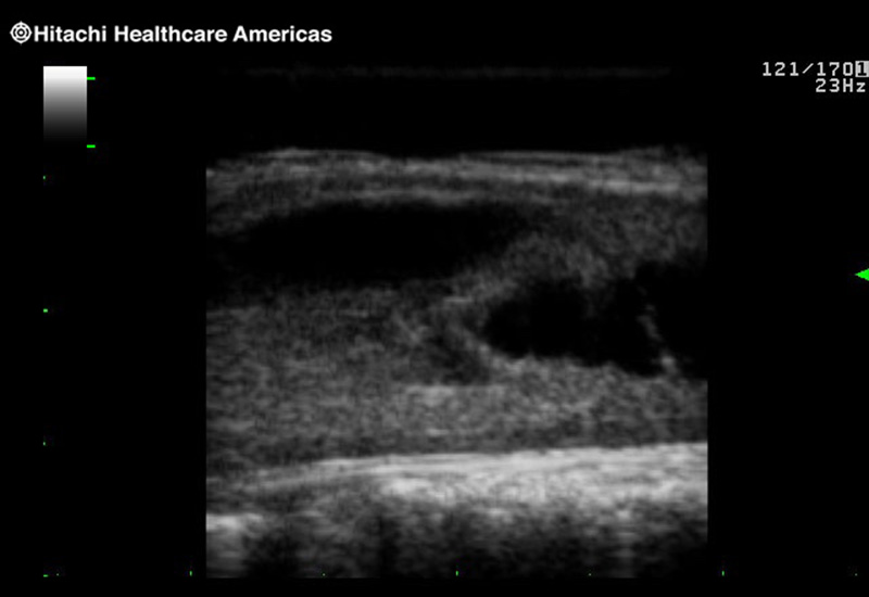 Spinal Cord Complex Tumor of Thoracic Spinal Cord