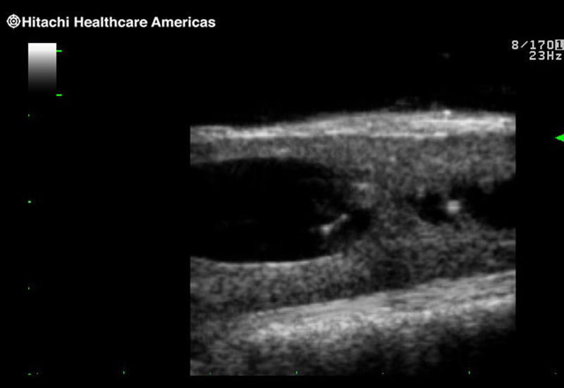 Spinal Cord Complex Tumor of Thoracic Spinal Cord