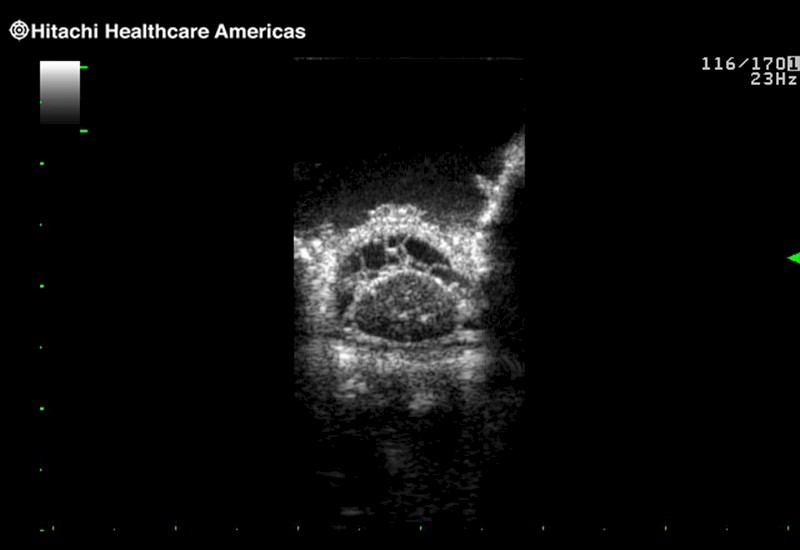 Spinal Cord Transverse View Sub Arachnoid Space
