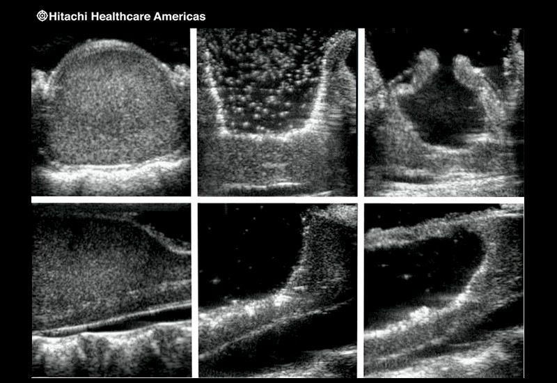 Pediatric Spinal Cord Tumor Sequence