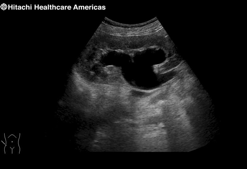 Kidney Hydronephrosis