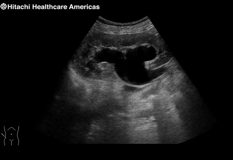 Kidney Hydronephrosis