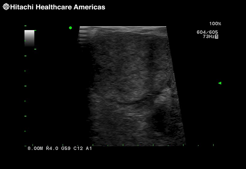 RAPN with Trapezoid Imaging