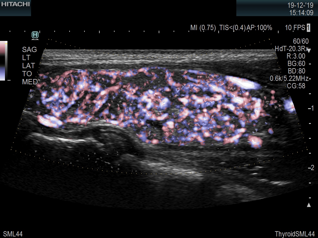 Thyroid EFlowGlossyTrapezoid 10