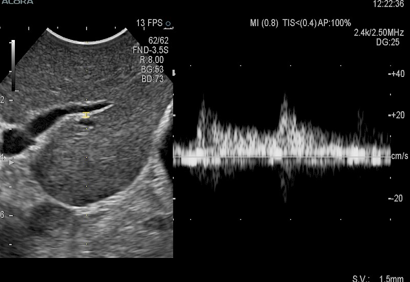 Liver Doppler 9