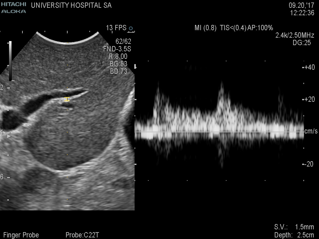 Liver Doppler 9