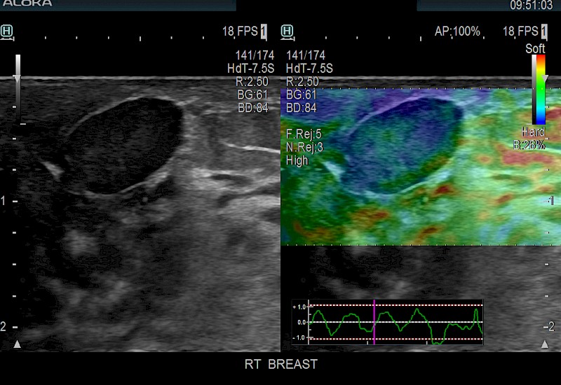 Breast Nodule Elastog 8