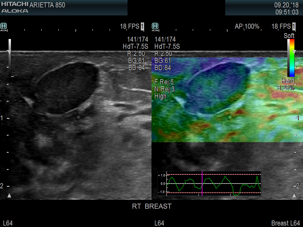 Breast Nodule Elastog 8