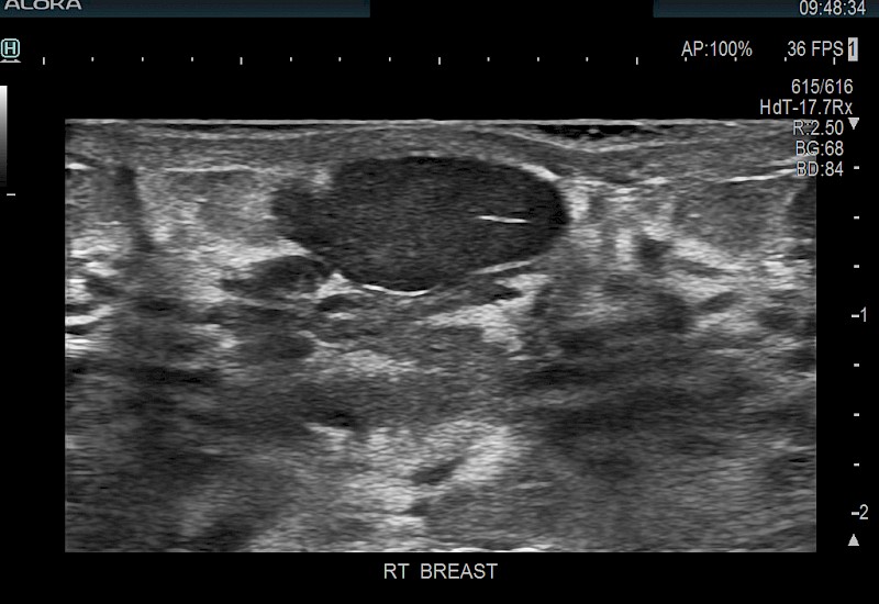 Breast Nodule SCITHI 9