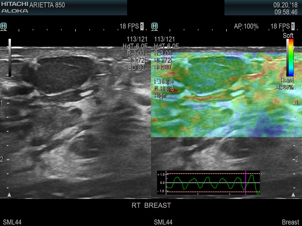Breast Nodule Elasto 8