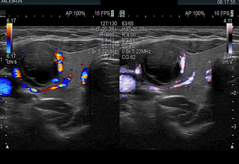 Thyroid Nodule DualColorEflow 10