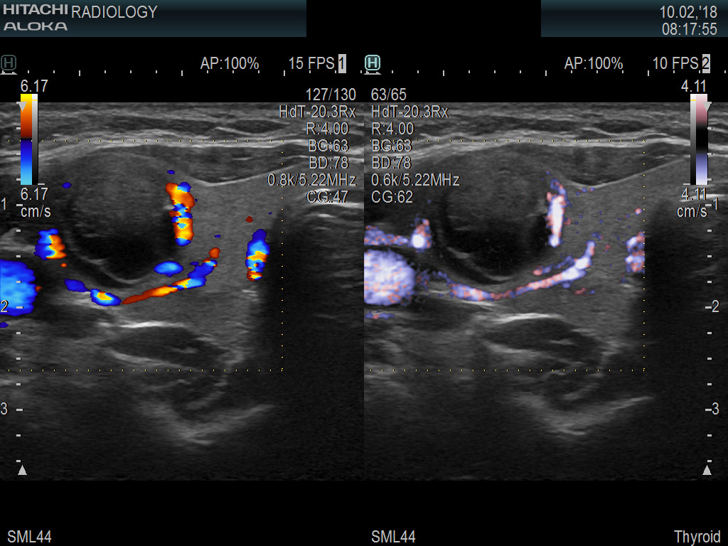 Thyroid Nodule DualColorEflow 10