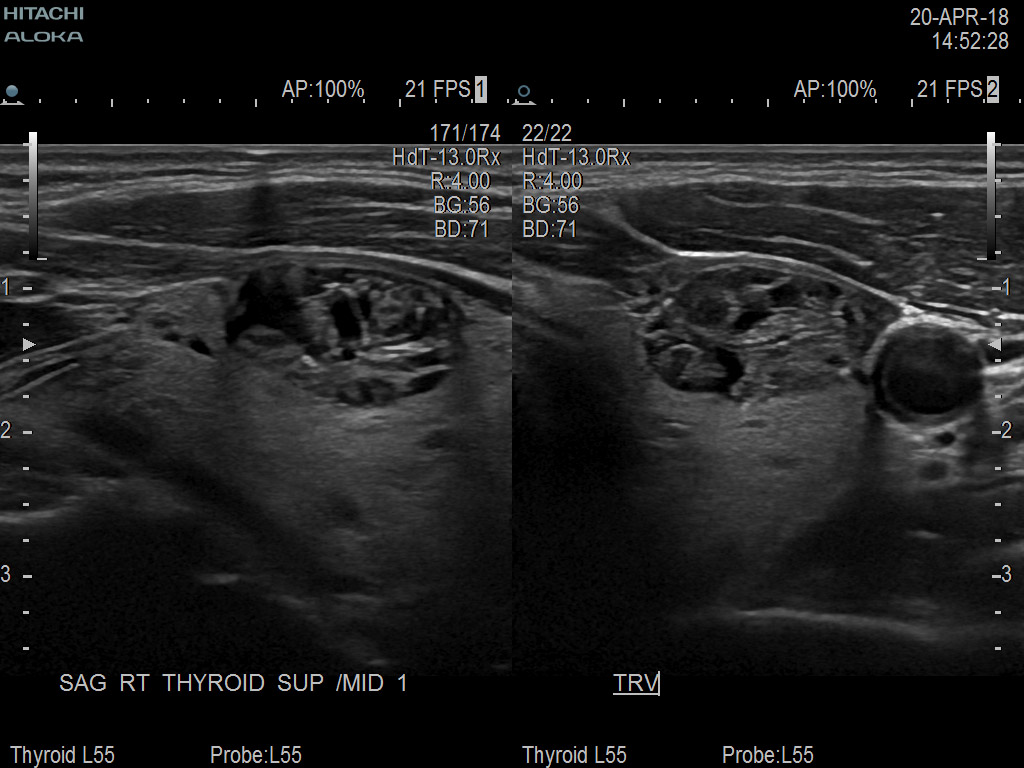 Thyroid Lesions Dual 9